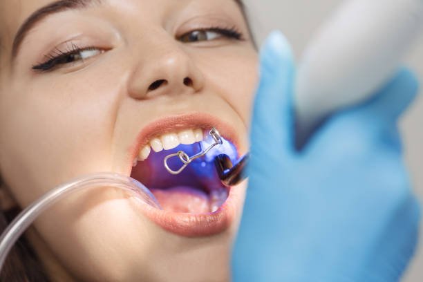 Dental Bonding in Greater Noida West