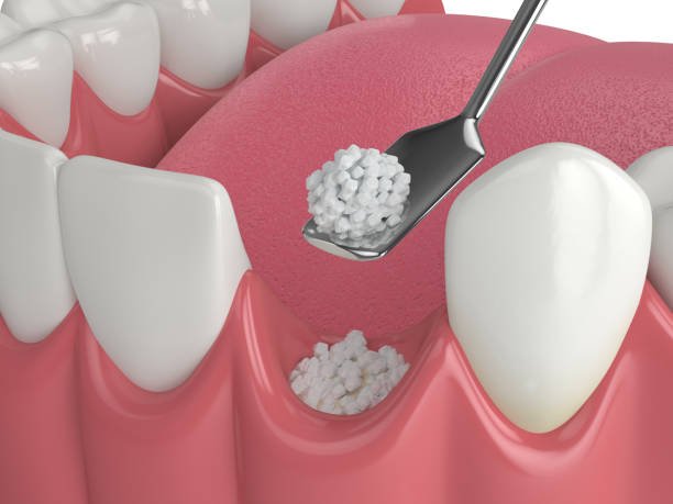 Bone Grafting in Greater Noida West