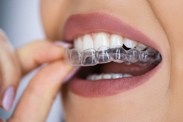 Clear Aligners in Greater Noida West