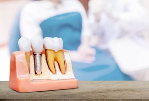 Best Dental Implant clinic in Greater Noida West