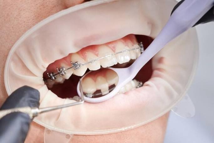 Orthodontic Treatment in Greater Noida West