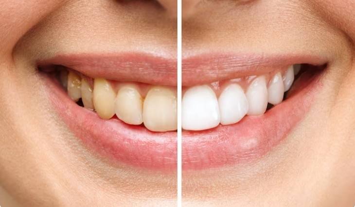 Affordable teeth whitening in Greater Noida