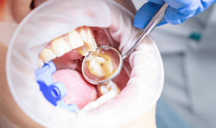 Affordable Dental Fillings in Saini