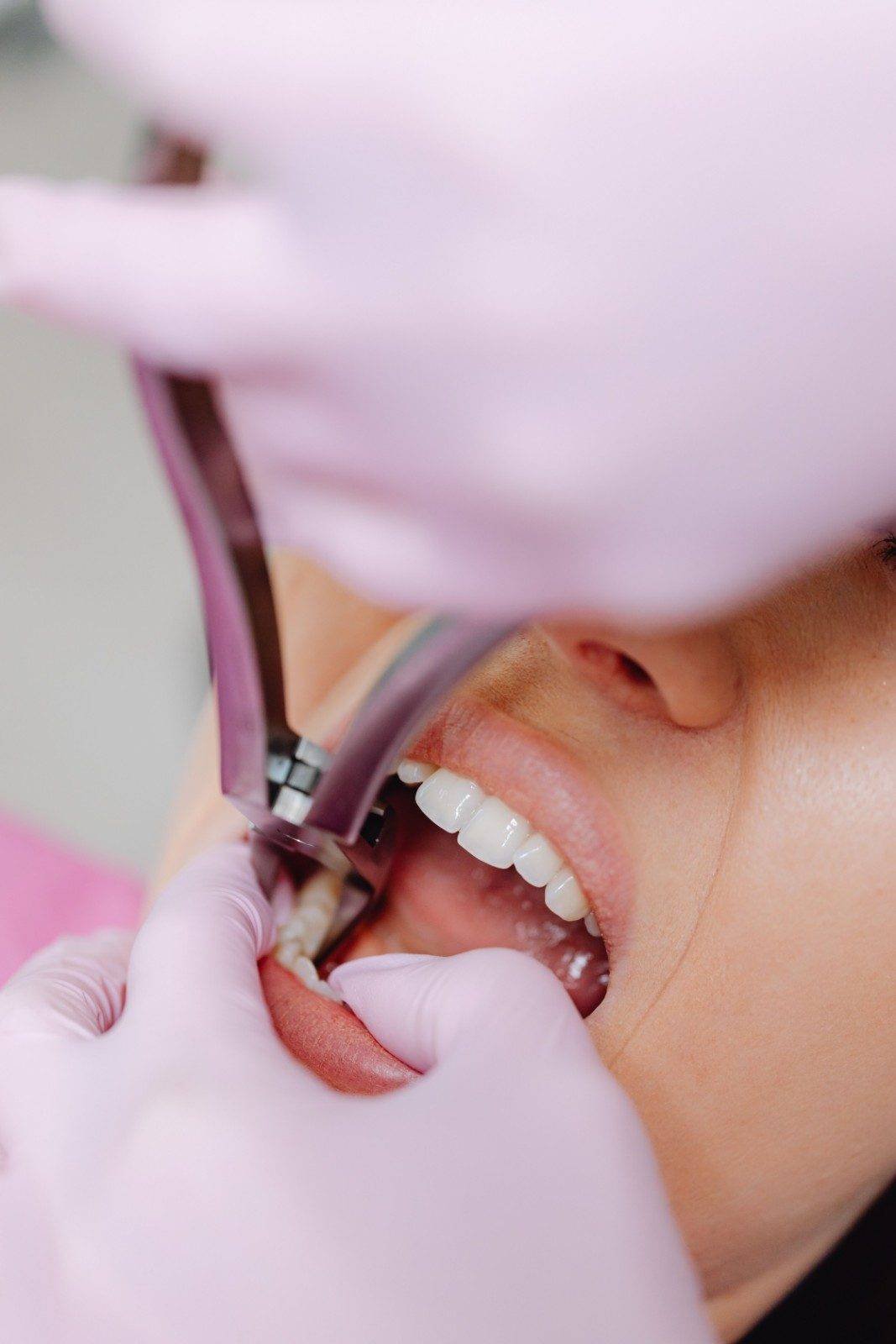 Tooth Extractions in Greater Noida West