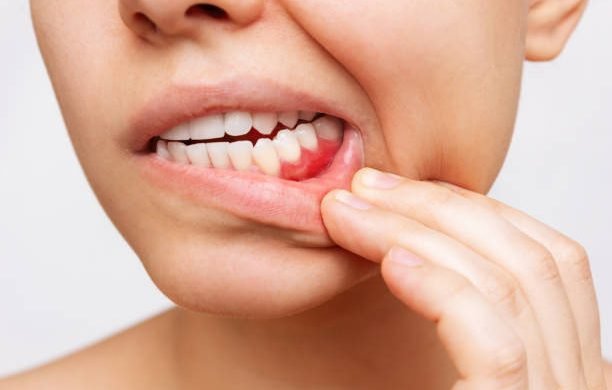Gum inflammation. Cropped shot of a young woman showing red bleeding gums isolated on a white background. Close up. Dentistry, dental care